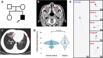 Case Report: Whole-Exome Sequencing-Based Copy Number Variation Analysis Identified a Novel DRC1 Homozygous Exon Deletion in a Patient With Primary Ciliary Dyskinesia